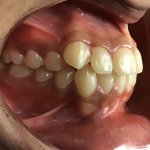 smile Before Orthodontics