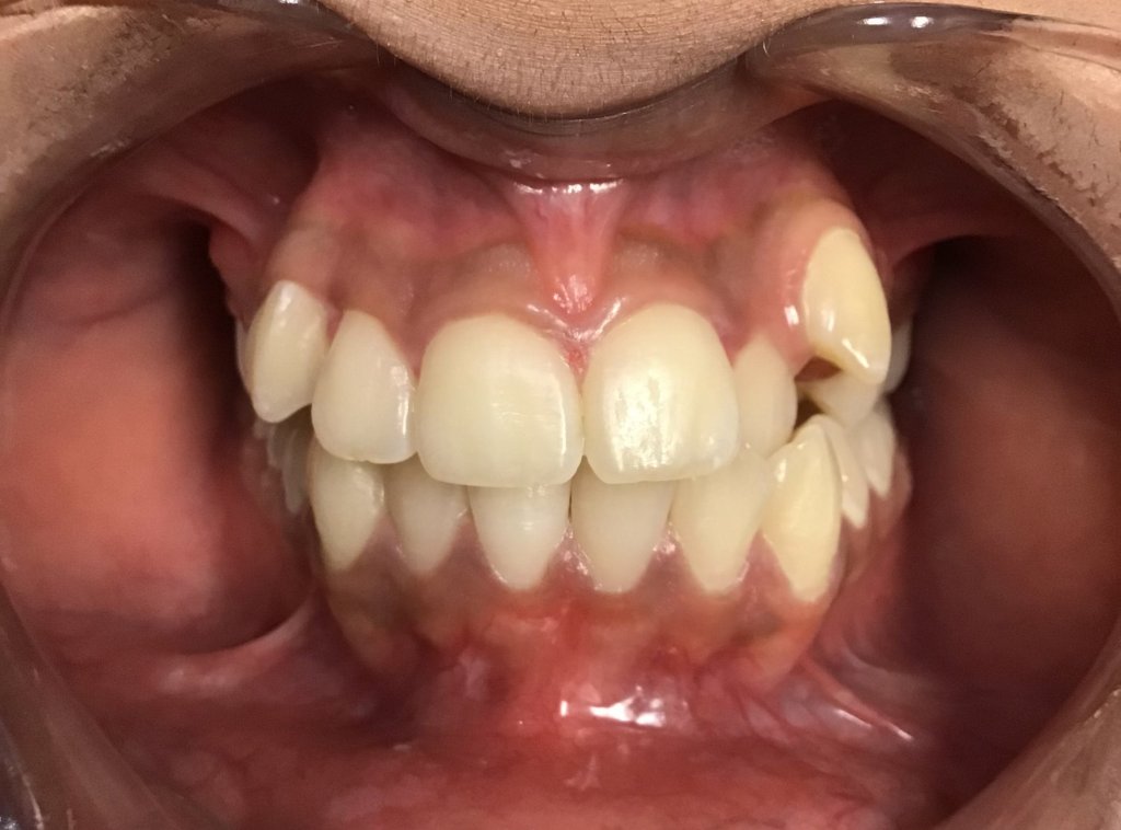 Before Orthodontics