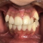 Before Orthodontics