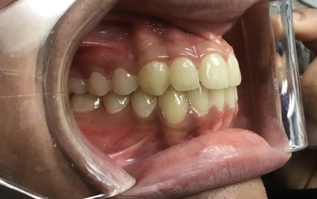smile After Orthodontics