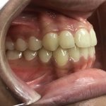 smile After Orthodontics