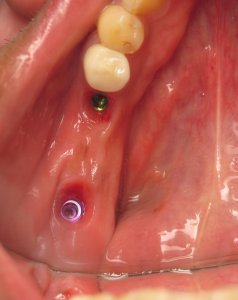 Teeth replaced with two implants