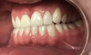 After Porcelain Crowns