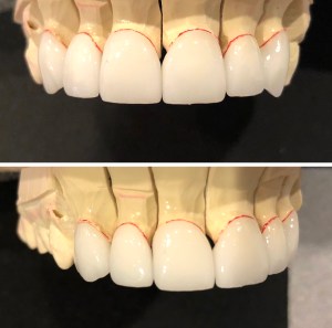 Porcelain crowns on model
