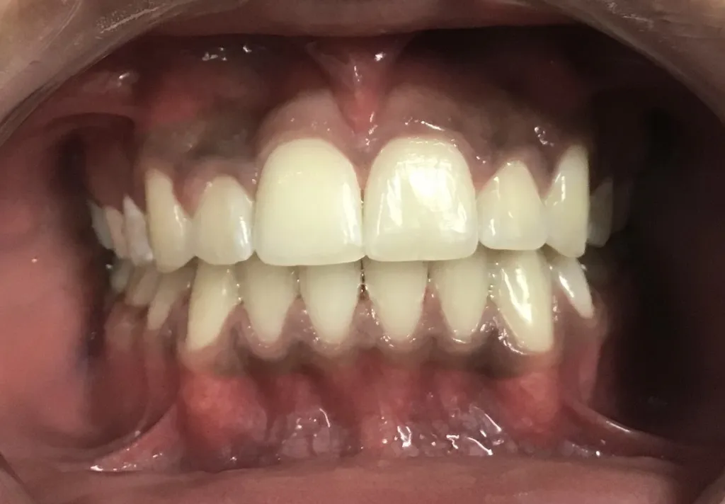 After Orthodontics