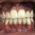 After Orthodontics