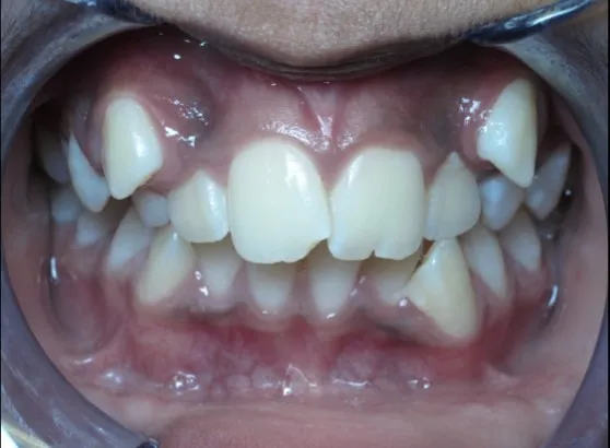 Before Orthodontics