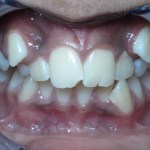 Before Orthodontics