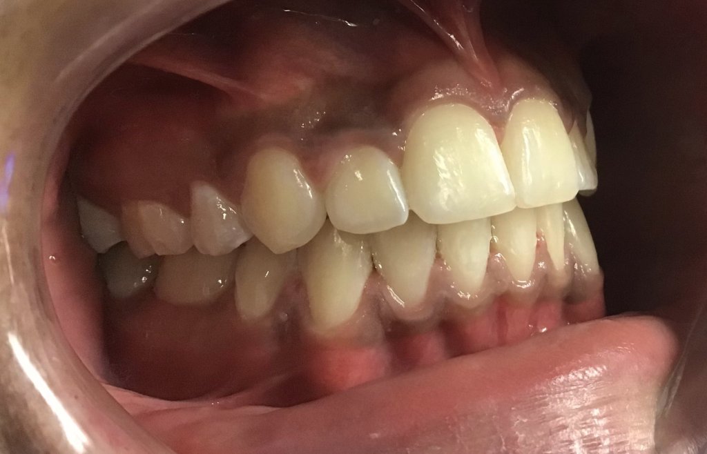 After Orthodontics