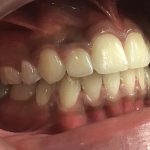 After Orthodontics