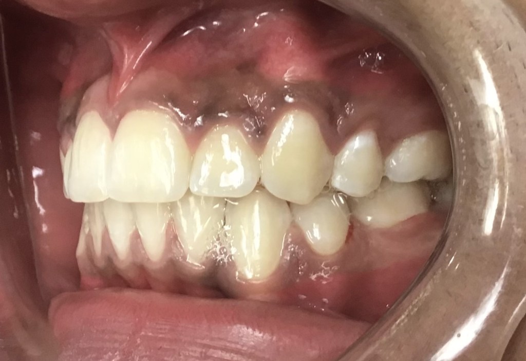 After Orthodontics