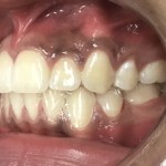 After Orthodontics