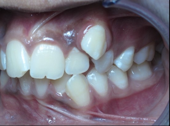 Before Orthodontics