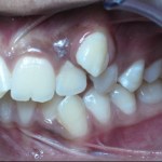 Before Orthodontics