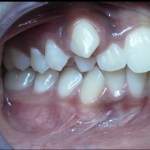 Before Orthodontics