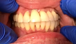 One crown placed on a tooth