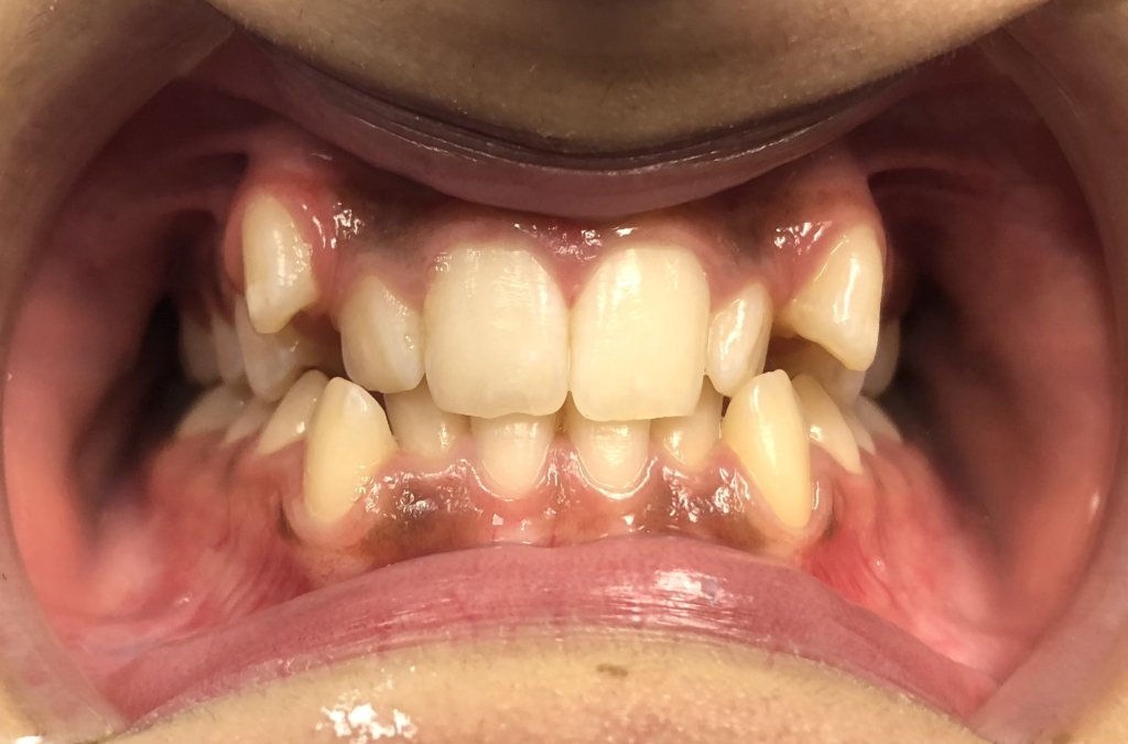 smile Before Orthodontics
