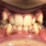 smile Before Orthodontics