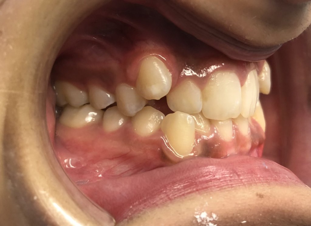 smile Before Orthodontics