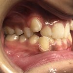 smile Before Orthodontics