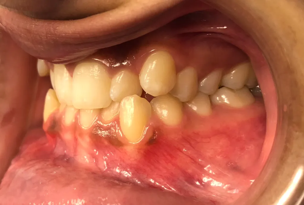smile Before Orthodontics