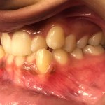 smile Before Orthodontics