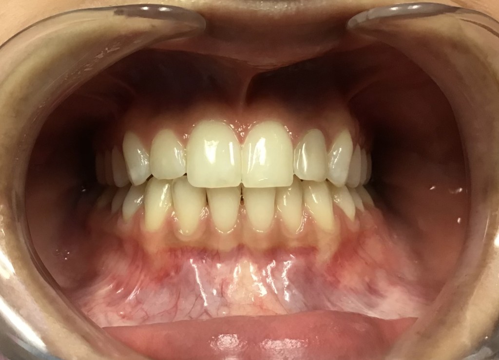 smile After Orthodontics