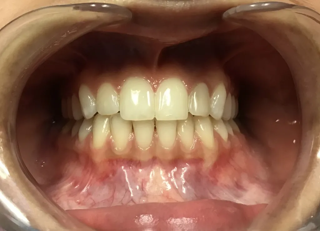 smile After Orthodontics