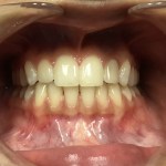 smile After Orthodontics