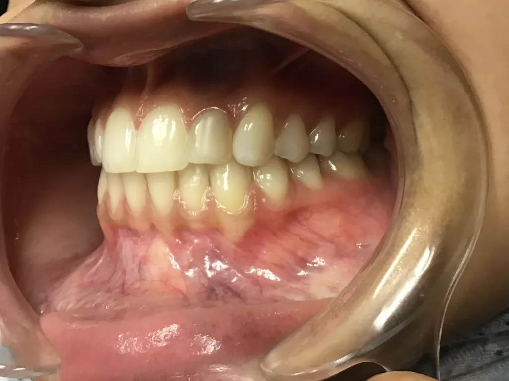 smile After Orthodontics