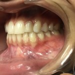 smile After Orthodontics