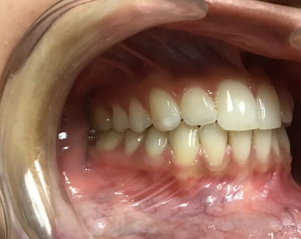 smile After Orthodontics
