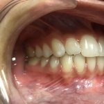 smile After Orthodontics