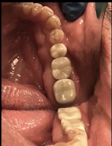 Crown placed on an implant