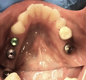 Three teeth replaced with implants