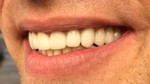 After Porcelain Crowns