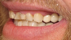 Before Porcelain Crowns