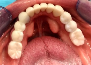 After Porcelain Crowns