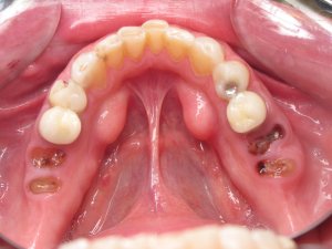 Before Porcelain Crowns