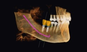 3D image of a jaw with two dental implants