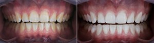 Before and after teeth whitening