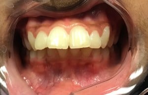 smile of before orthodontic treatment