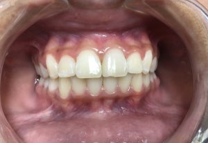 smile of after orthodontic treatment