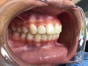 mouth showing after orthodontic treatment