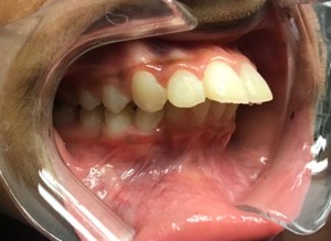 mouth showing before orthodontic treatment